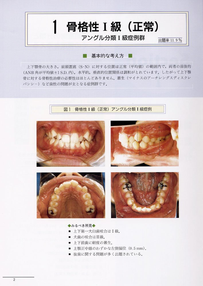 ▲01)【同梱不可】歯科矯正臨床シリーズ 4冊セット/その基礎と臨床/上顎前突/反対咬合/叢生/開咬/医歯薬出版/A 治療例No.104 正常咬合ではありません上下顎前突です。｜舌側